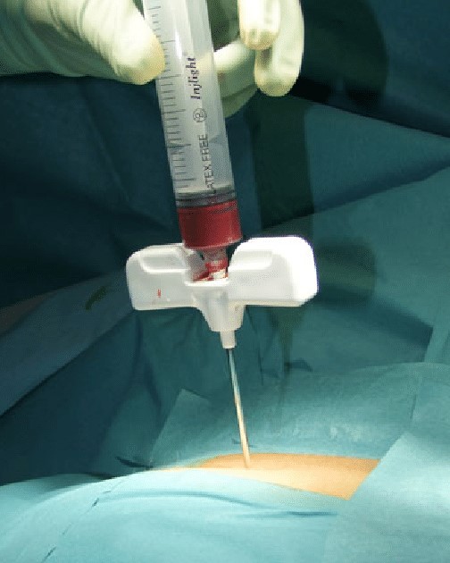 Bone Marrow Biopsy Aspiration Needles Welcome To Busse Hospital 